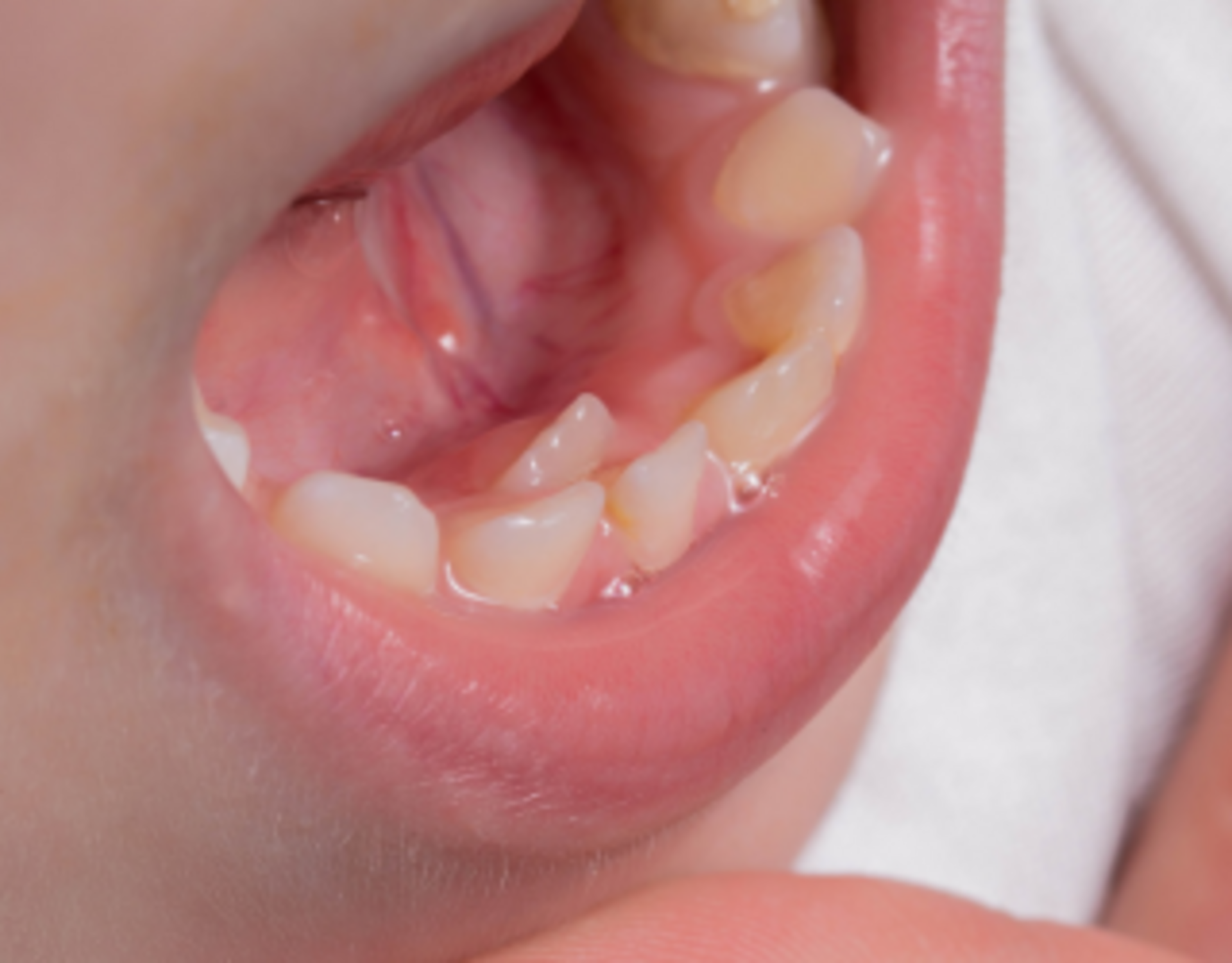 Jaw Growth Problems