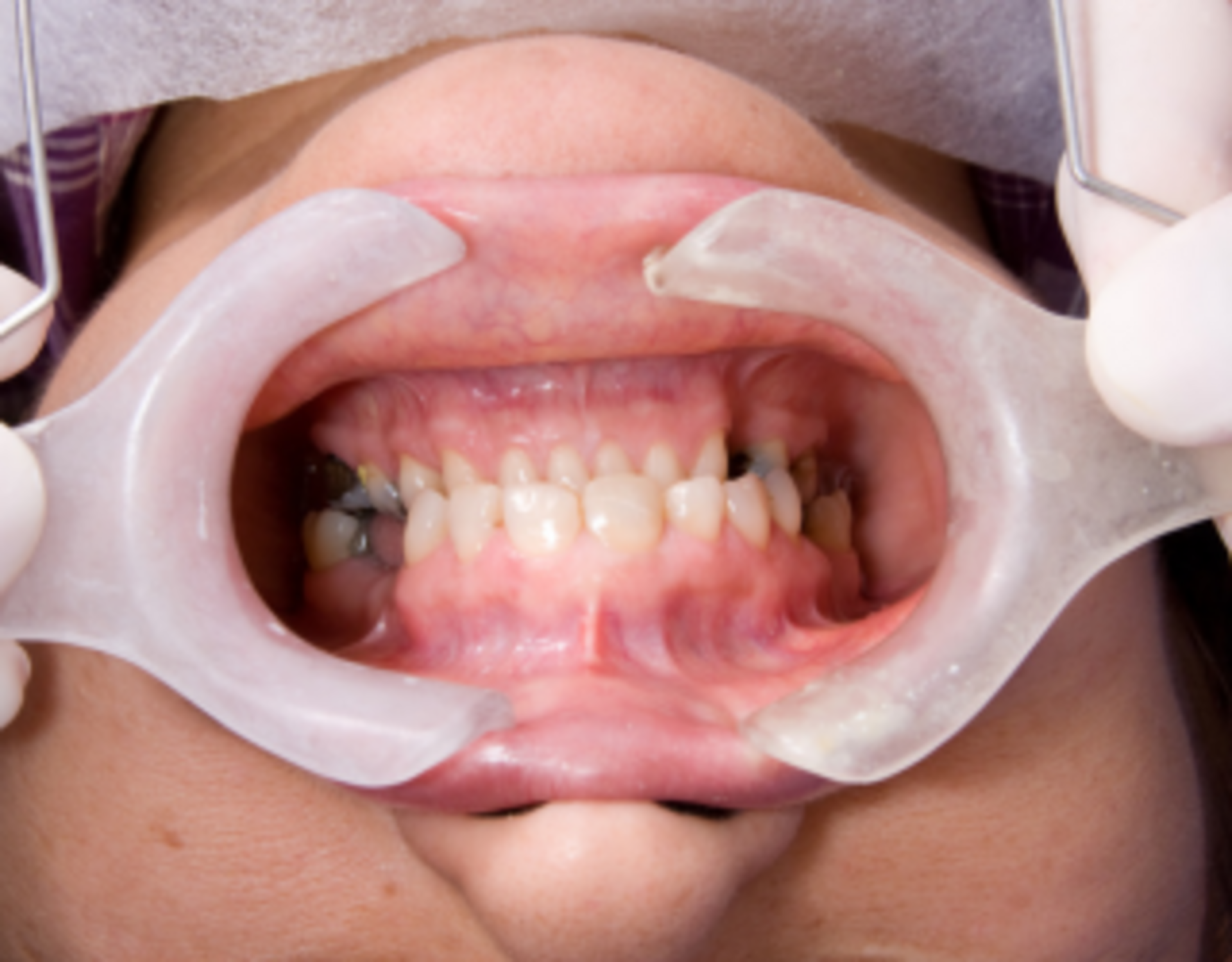 Full mouth rehabilitation