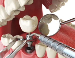 Dental Implants vs. Bridges: Expert Advice from an Oral Surgeon|Dr. Vishal Tapadiya