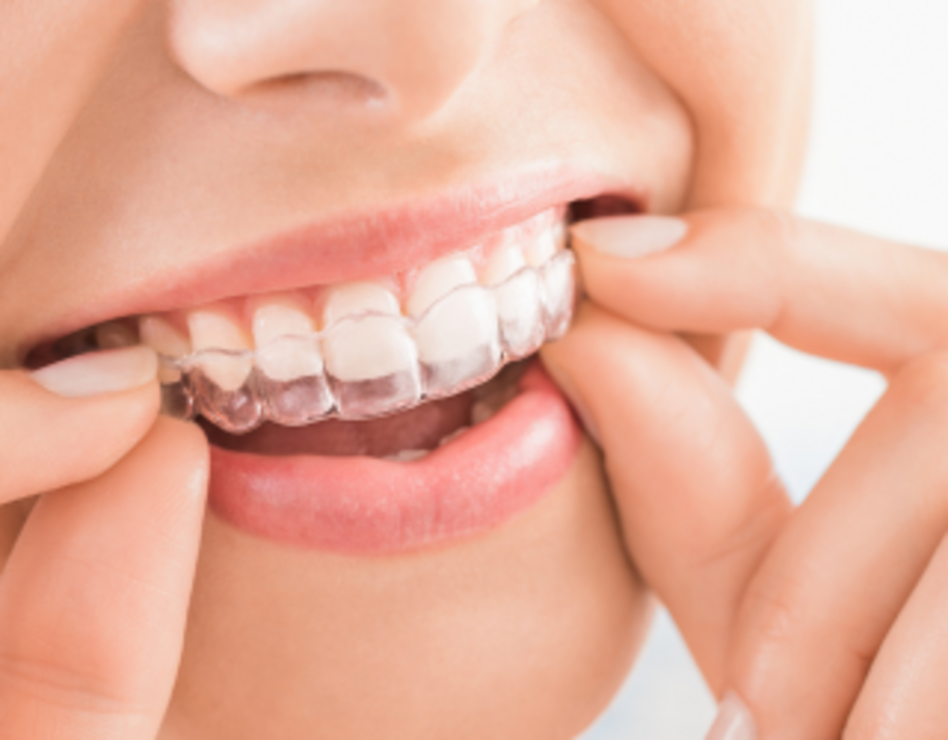 Braces vs. Aligners