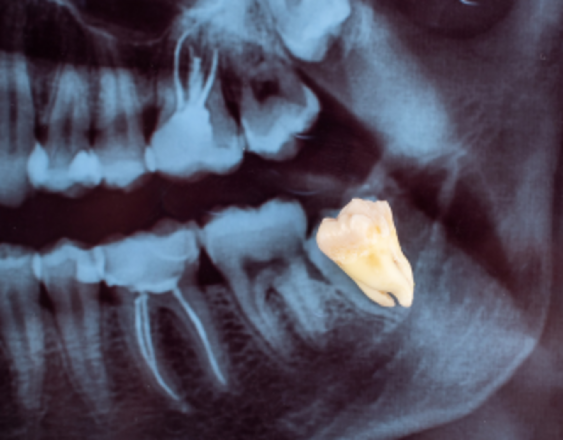Wisdom Tooth Extraction